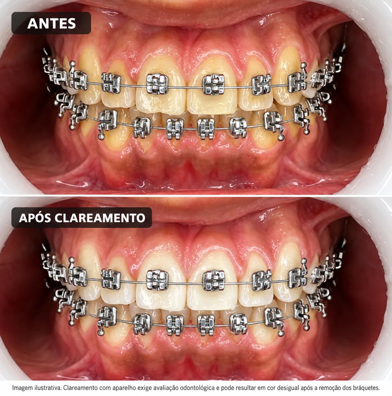 Dentes reais com aparelho antes e após clareamento ilustrativo