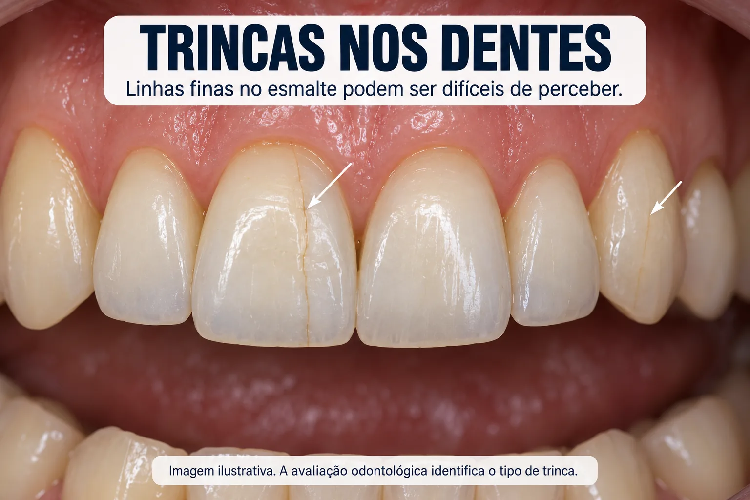 Dentes reais com linhas finas no esmalte