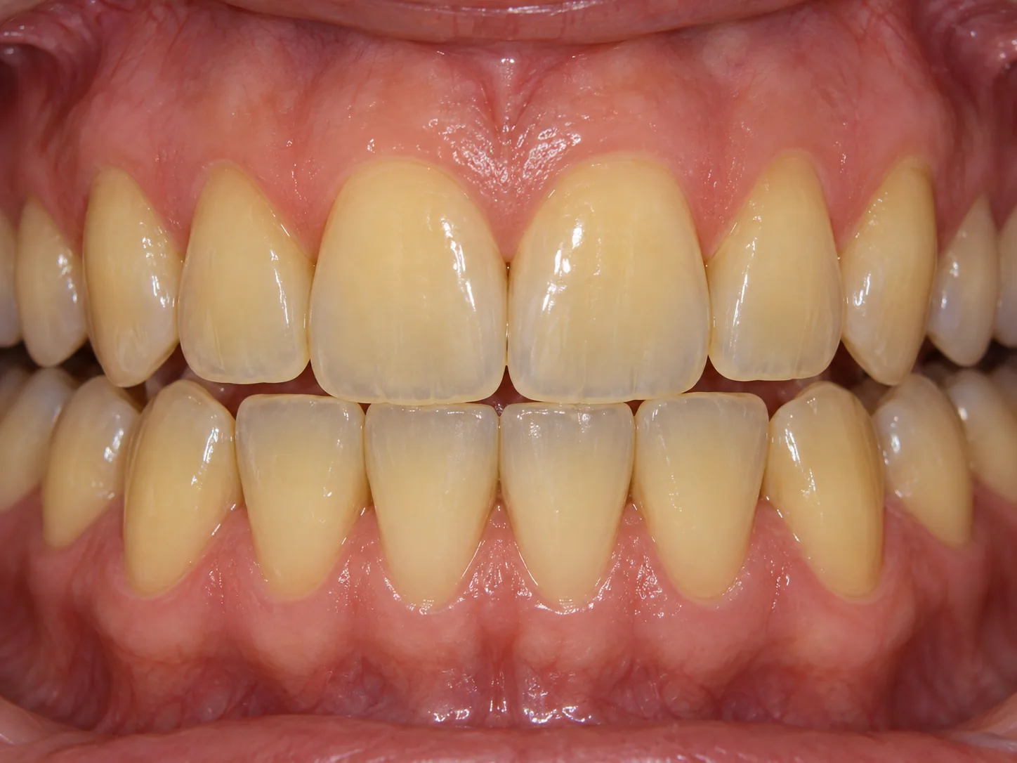 Sorriso real em tonalidade natural