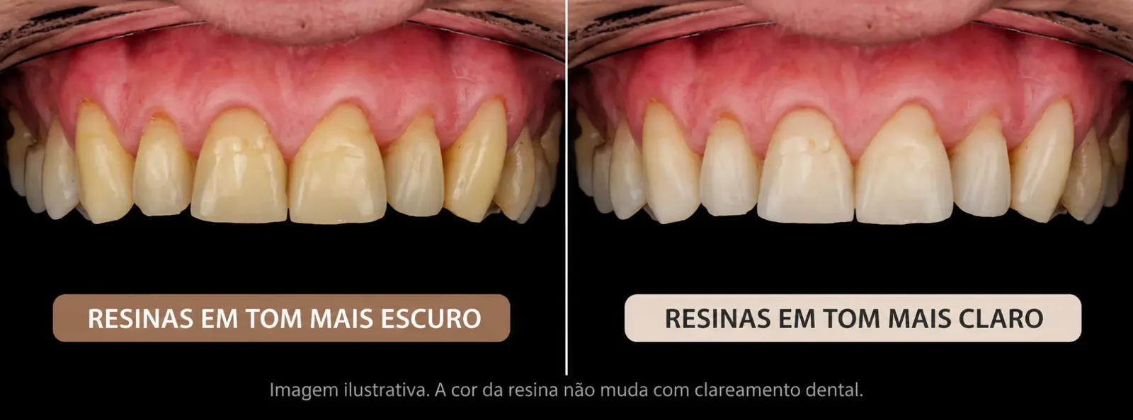 Imagem clínica ilustrativa de resinas dentárias em tonalidades diferentes